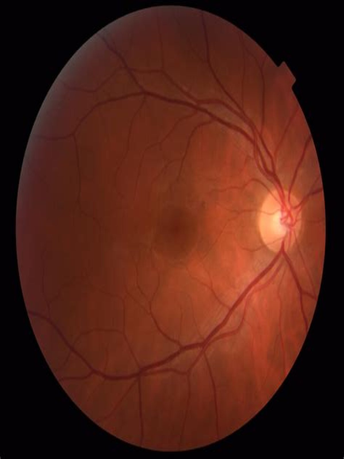 Can a retinal hole heal itself?