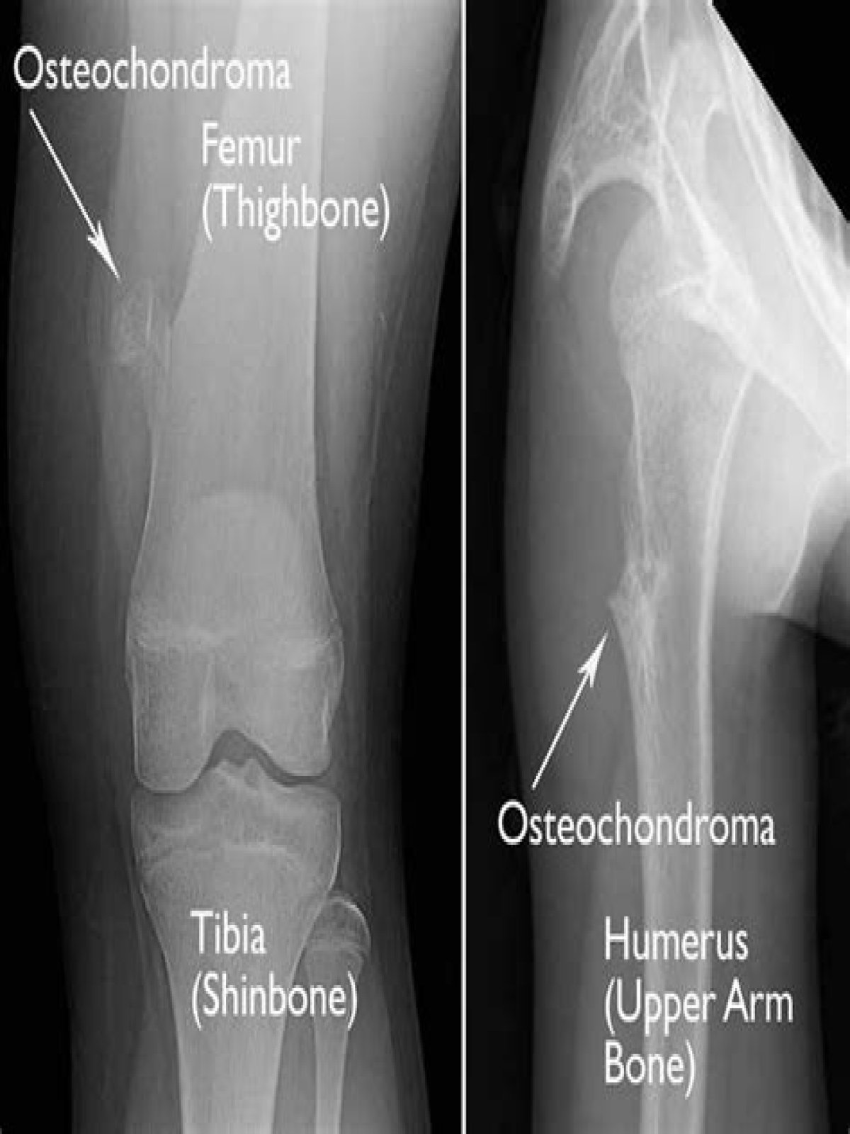 Should I worry about osteochondroma