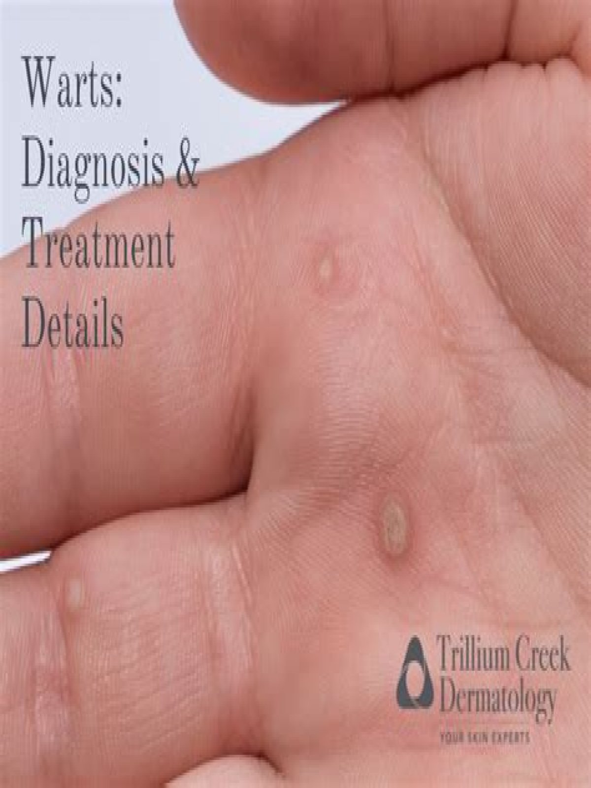 Why am I suddenly getting warts on my hands?